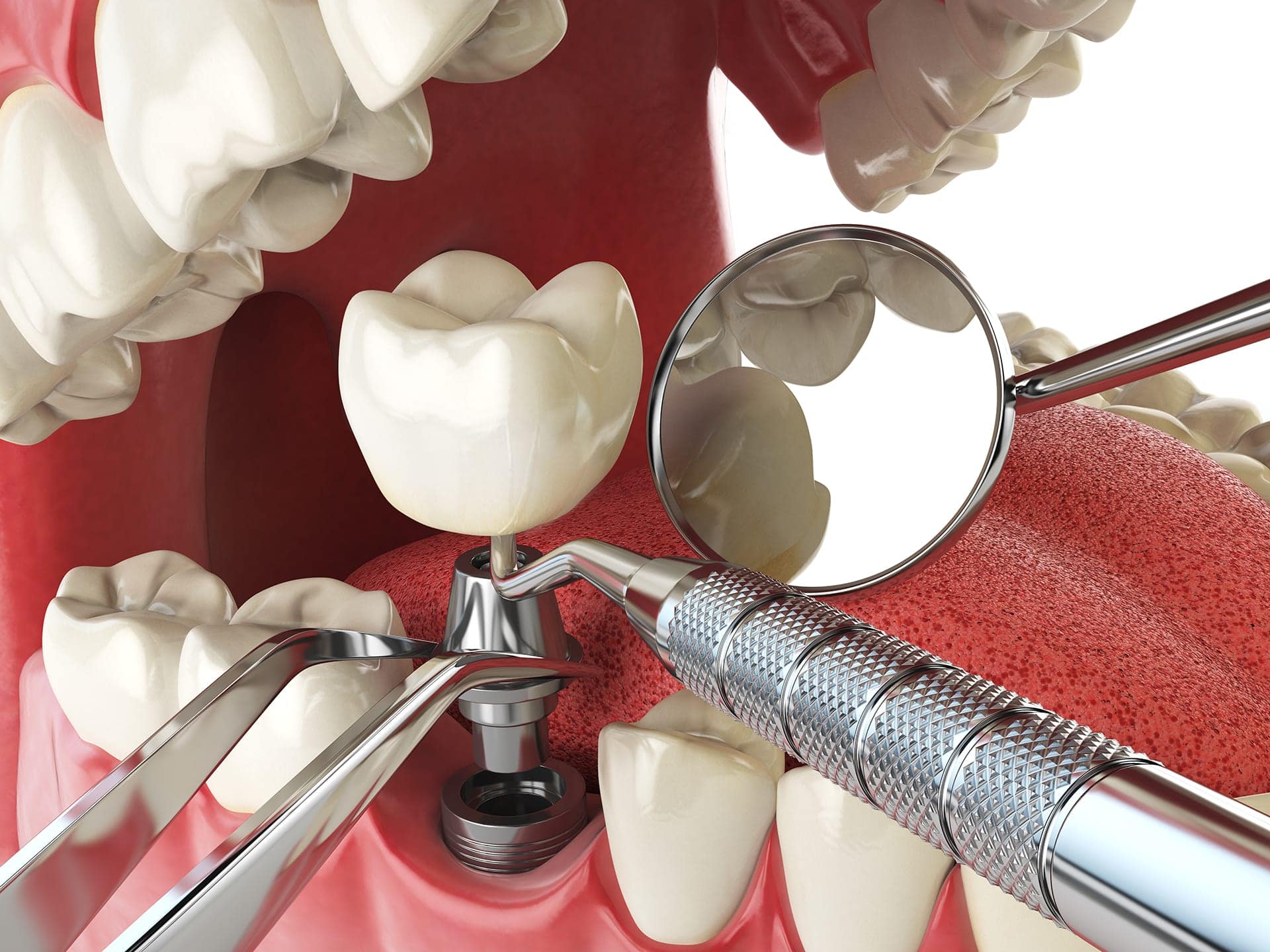 Dental Implants Dental & Denture Care Center Spring Hill Brooksville