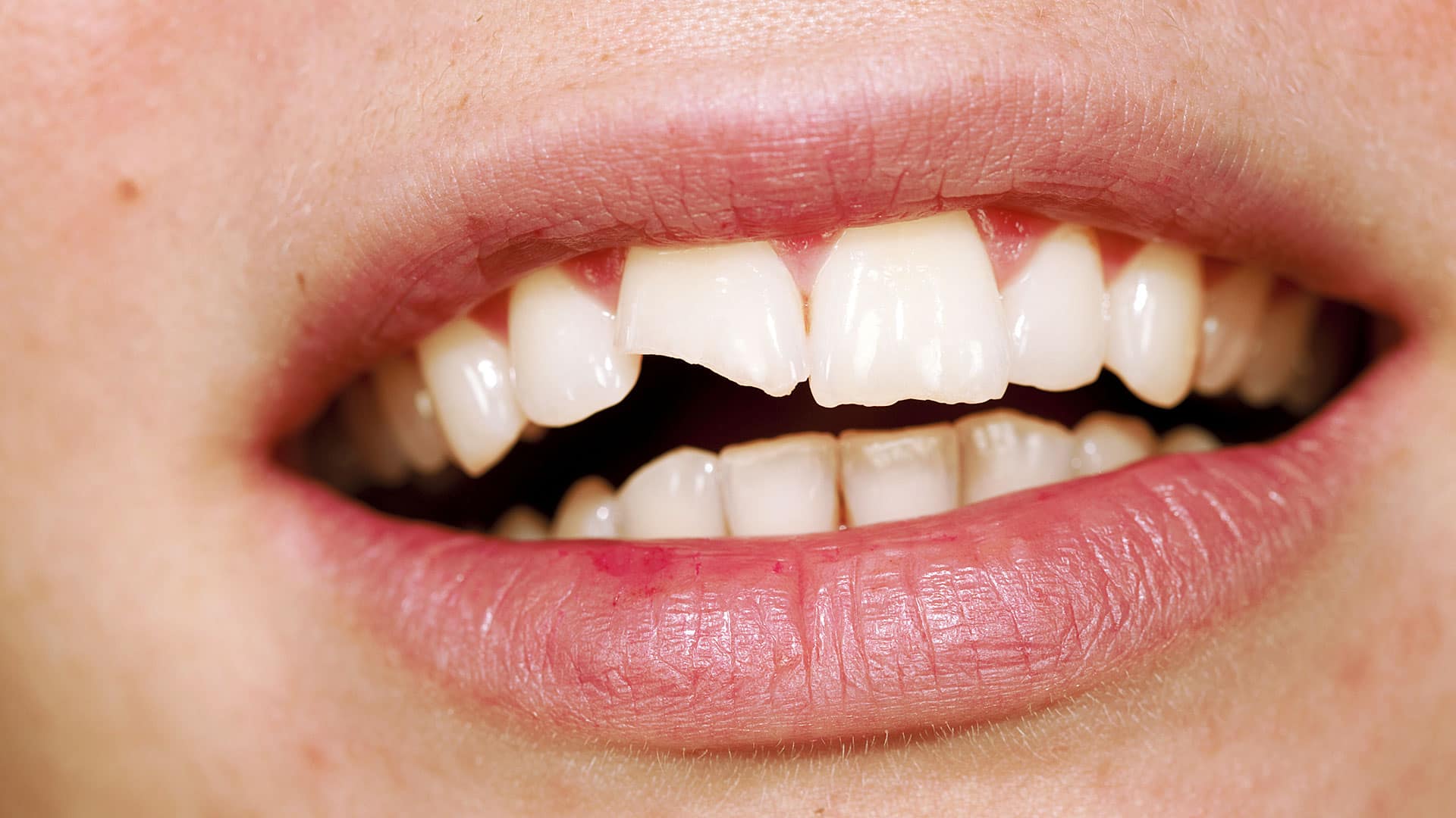 Chipped Tooth Repair The Dental and Denture Care Center Spring Hill